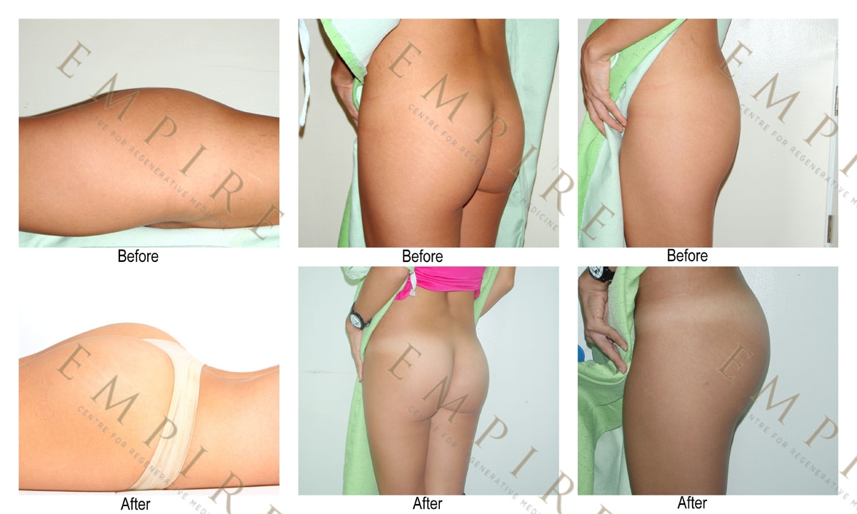 Brazilian Butt Lift (Condensed Rich Fat Injection To Enhance Buttocks)